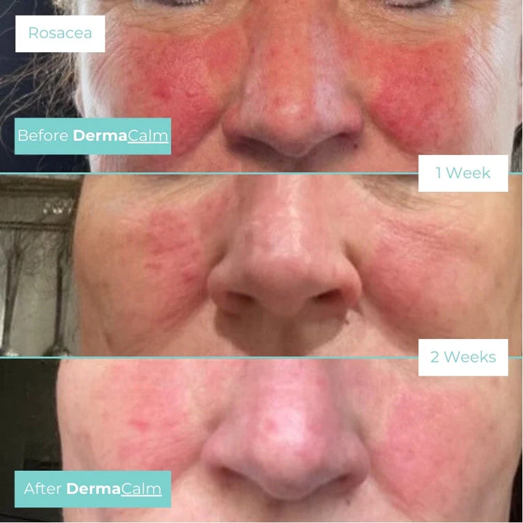 Dermacalm Aftercare Spray 30ml - Image 3