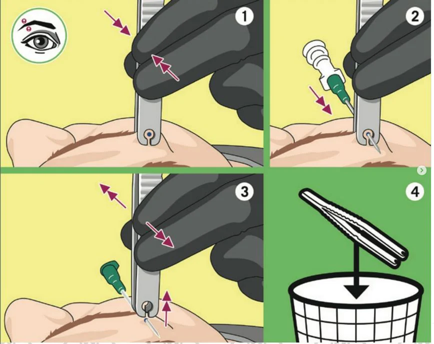Snaptile Disposable Open Piercing Forceps (Round & Triangle) - Image 3